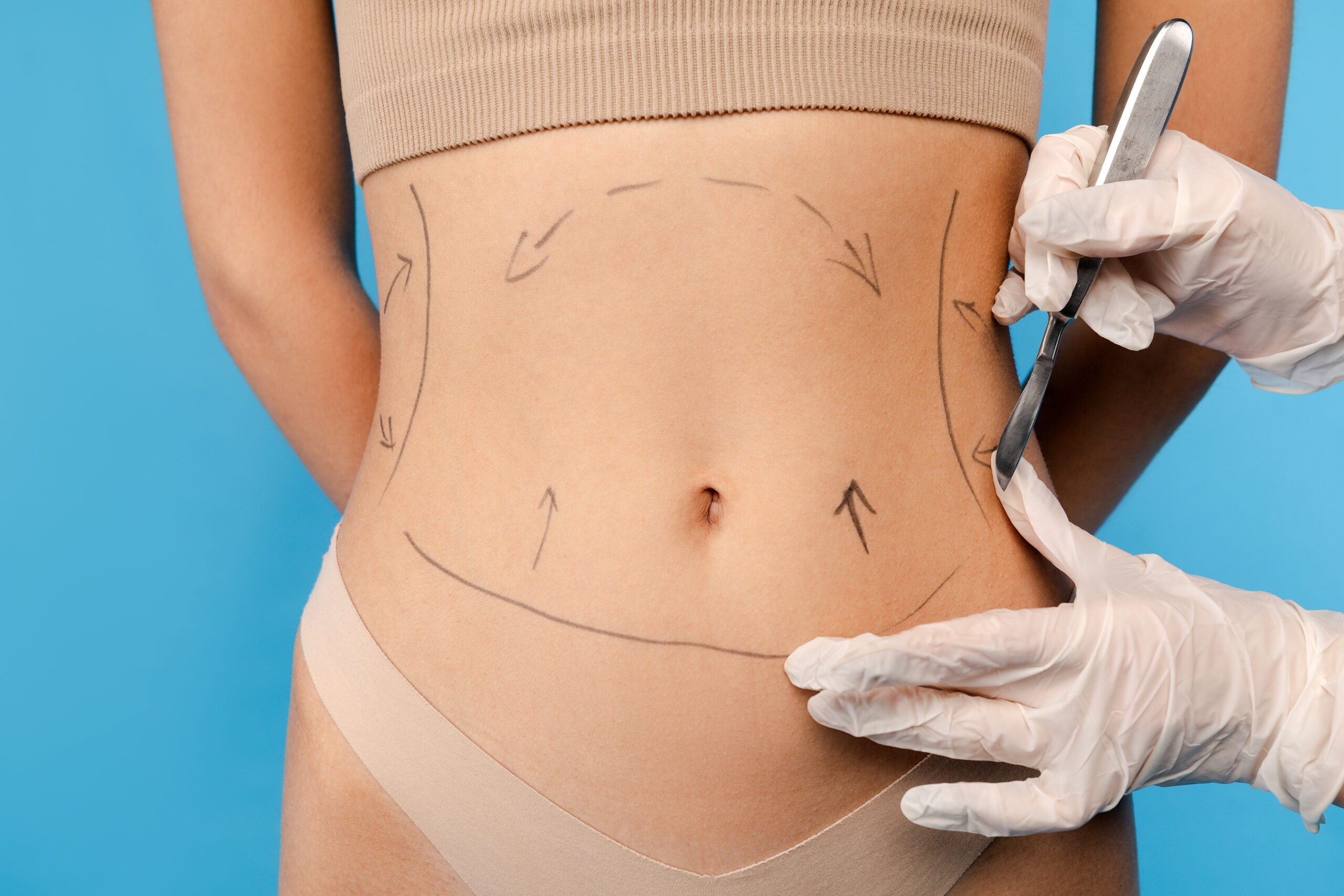 Vaser Liposuction