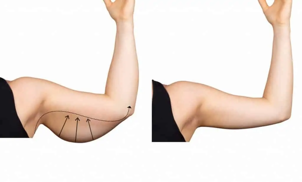 Kol Germe Ameliyatı fiyatlari