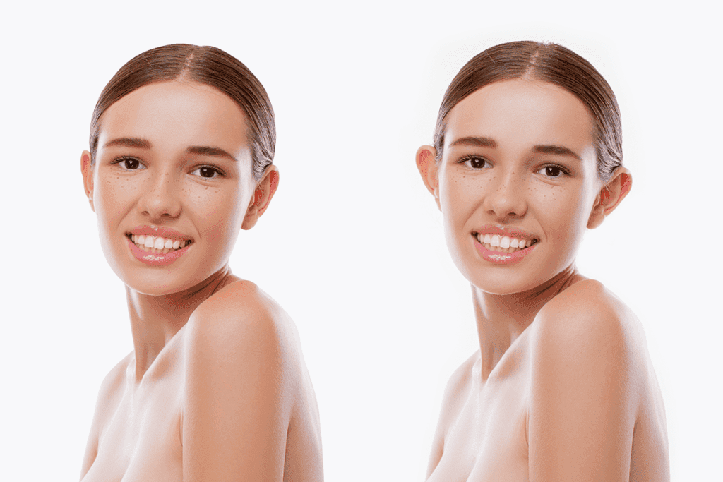 Kepçe Kulak Estetiği