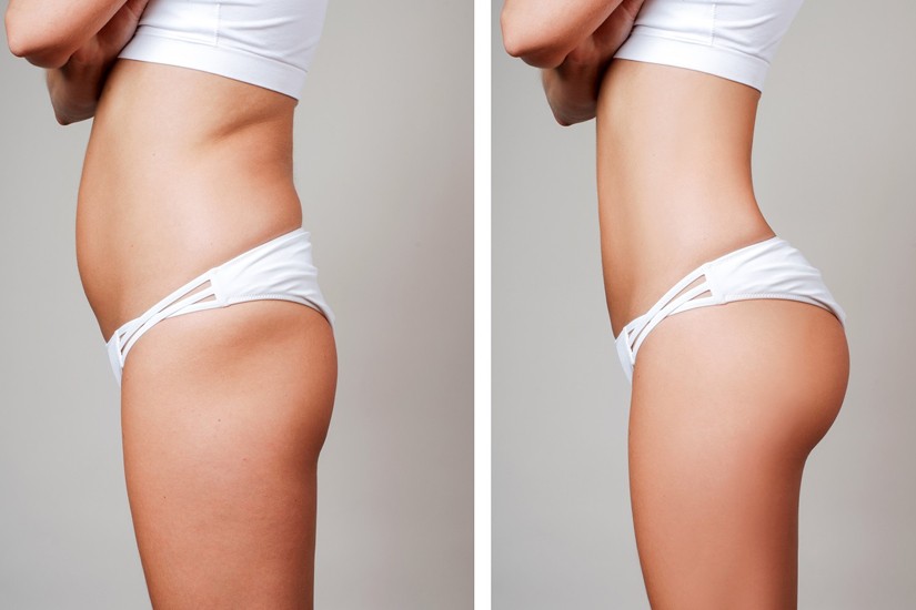 Kalça Dikleştirme Estetiği